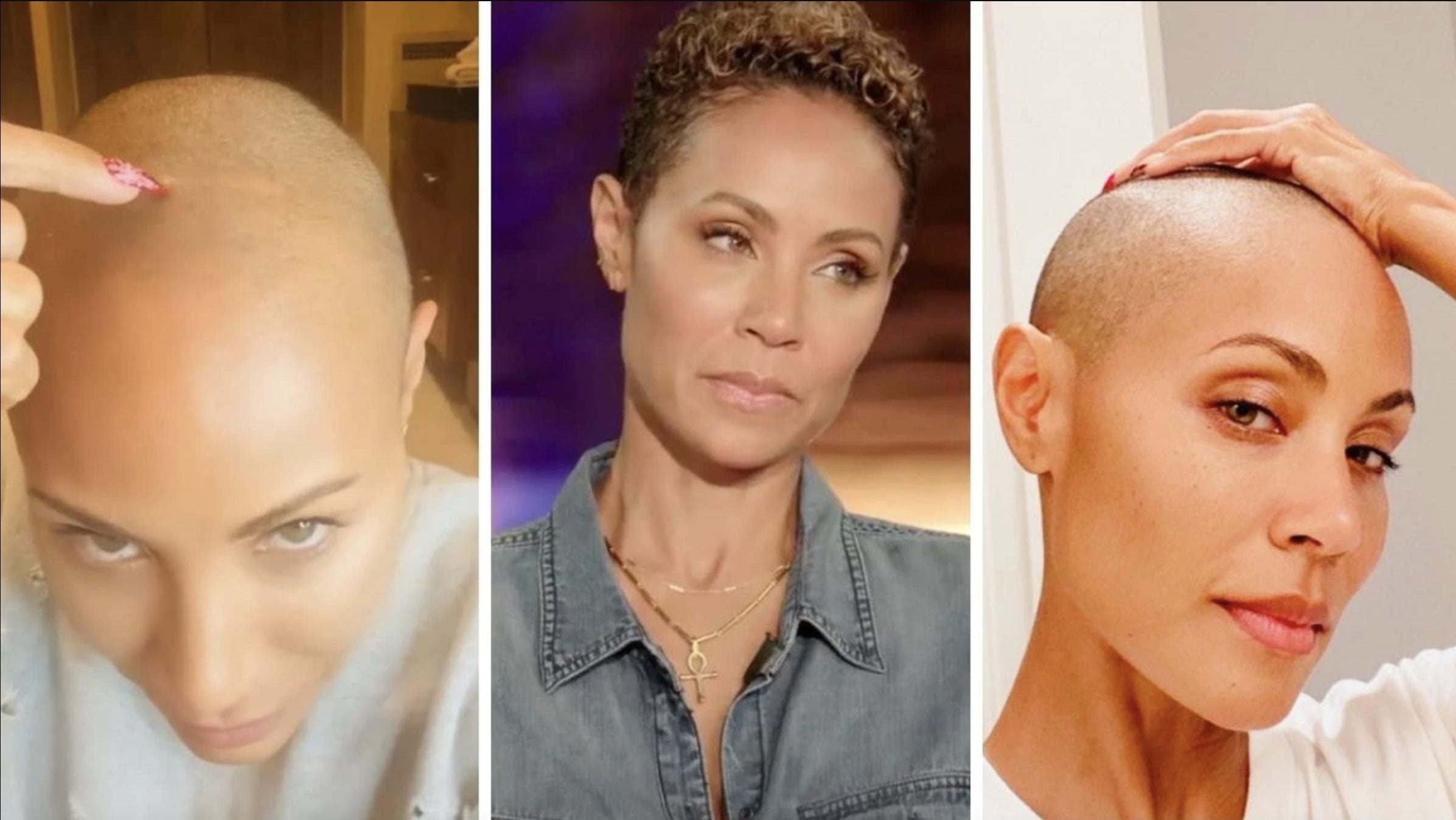 Celebrities with Alopecia