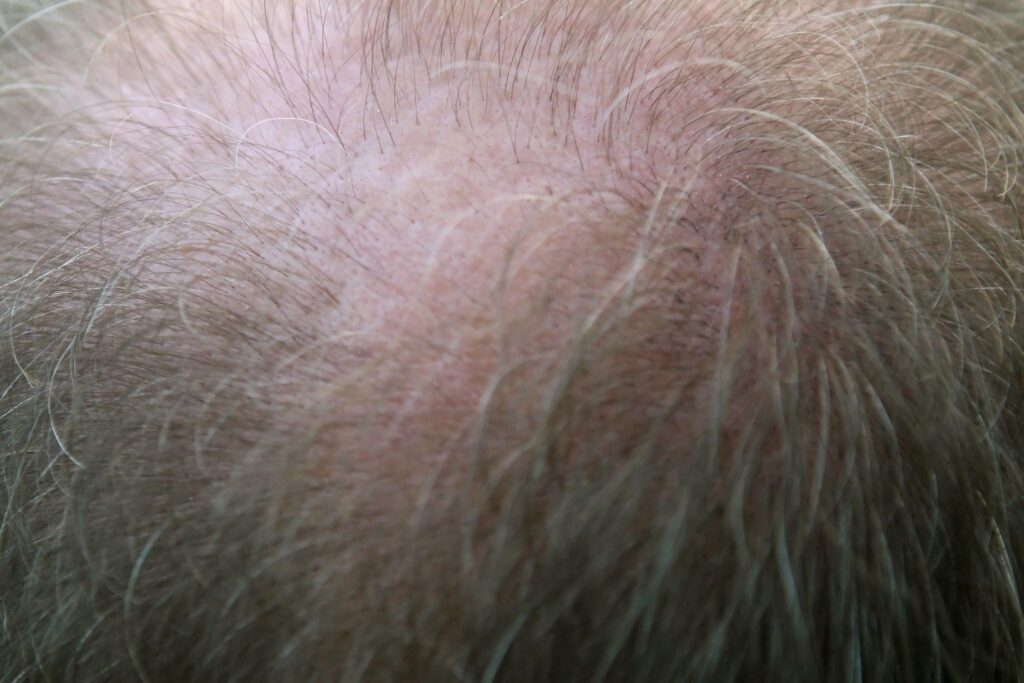 Hair Loss Reasons