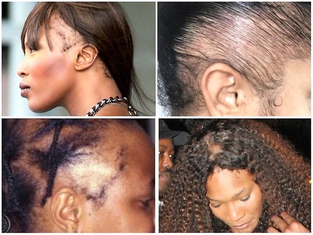 Traction Alopecia: What Is It And How To Deal With It?