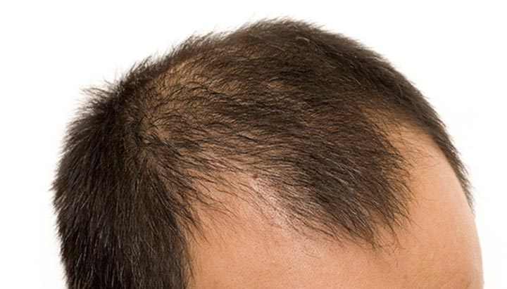 Male pattern baldness solution